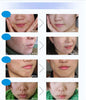 BIOAQUA Brand Skin Care Face Acne Treatment Cream 30g